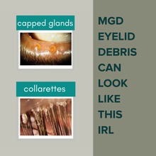 Load image into Gallery viewer, Posterior Blepharitis MGD Cleansing System