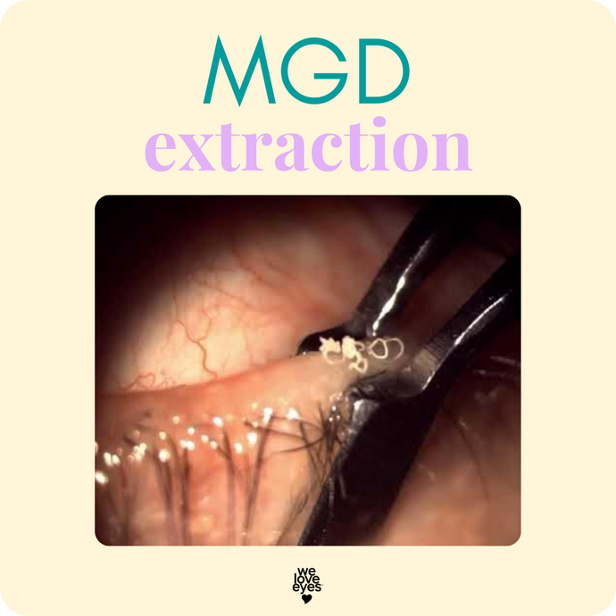 Optimal Frequency for MEIBOMIAN GLAND EXTRACTION When on ACCUTANE: A Guide