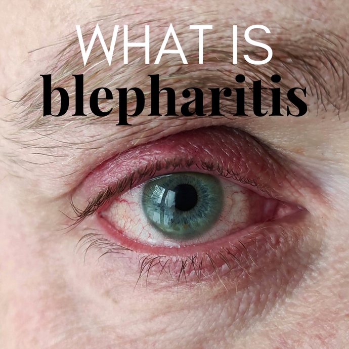 Blepharitis 101: Your Comprehensive Guide to Eyelid Inflammation & We Love Eyes Solutions