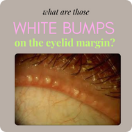 CLOGGED MEIBOMIAN OIL GLANDS  eyelid margin bumps  meibomian gland dysfunction  posterior blepharitis system  eyelid hygiene routine  warm compress for eyes  We Love Eyes blepharitis  lid massage techniques