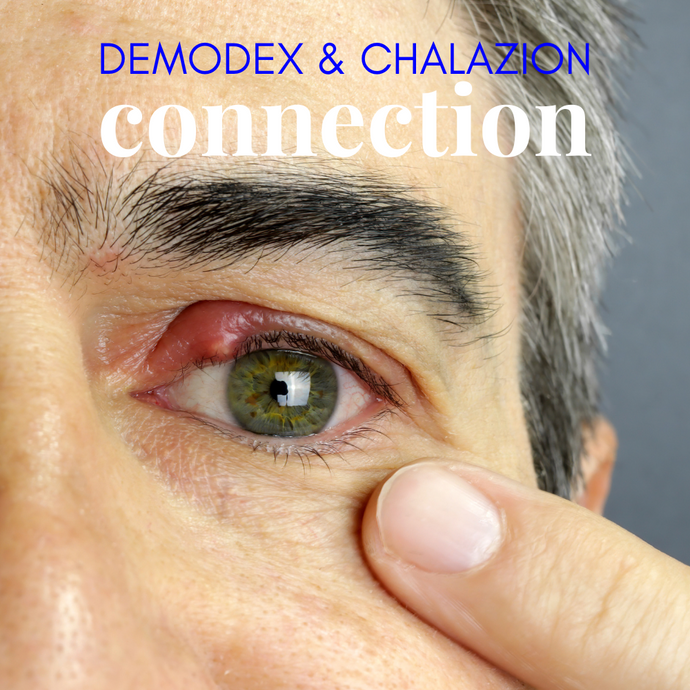 Understanding the Link Between Chalazion and Demodex Mites: Effective Eye Care Solutions
