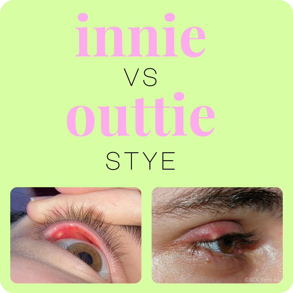 Upper Eyelid Stye Internal
