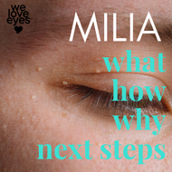 Milia Around the Eyes - What Causes Milia and How to Prevent Milia on Eyelids