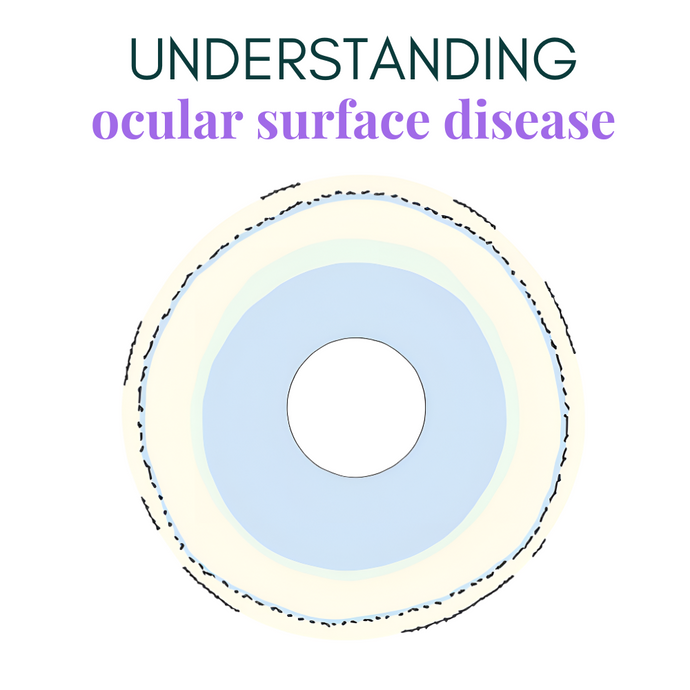 Understanding OCULAR SURFACE DISEASE: How to Combat Dry, Itchy Eyes and Protect Your Vision