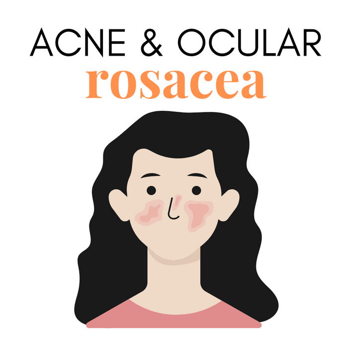 How Ocular Rosacea is Linked to Acne Rosacea: Understanding Causes, Symptoms, and Treatments
