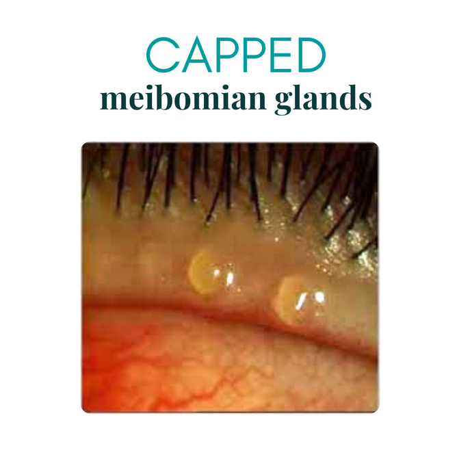 What Are Capped Meibomian Glands? Safe Removal Tips and Eye Care Essentials by We Love Eyes