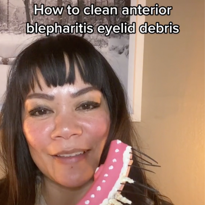 How to Clean Anterior Blepharitis Eyelid Debris