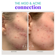 meibomian gland dysfunction, non-cystic acne, MGD, acne and eye health, ocular inflammation, hormonal imbalances, dry eye, skincare, We Love Eyes, optometry, eye care, Zilche Acne Formulas