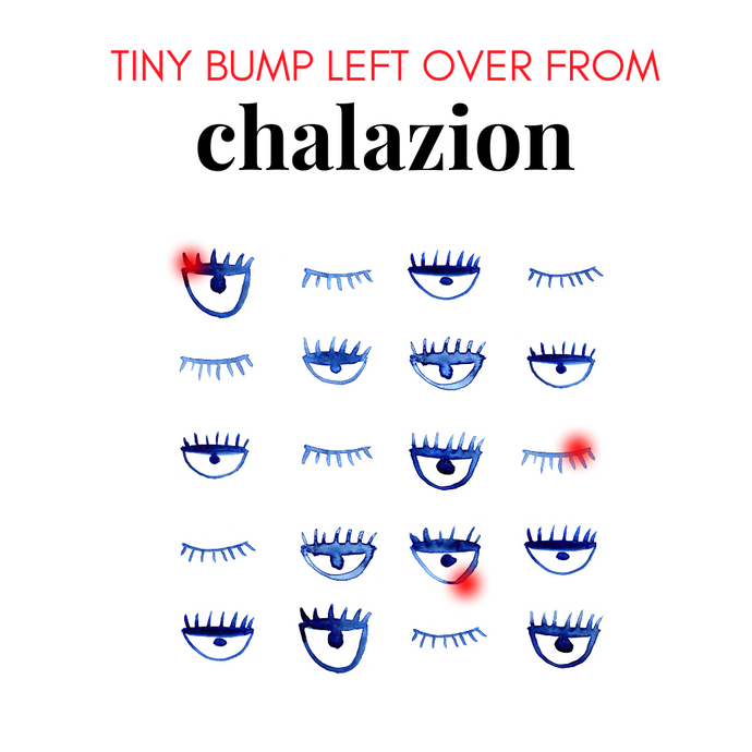 Effective Chalazion Drainage for Left Over Tiny Bump: Eye Care Solutions from We Love Eyes