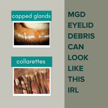Load image into Gallery viewer, Posterior Blepharitis MGD Cleansing System
